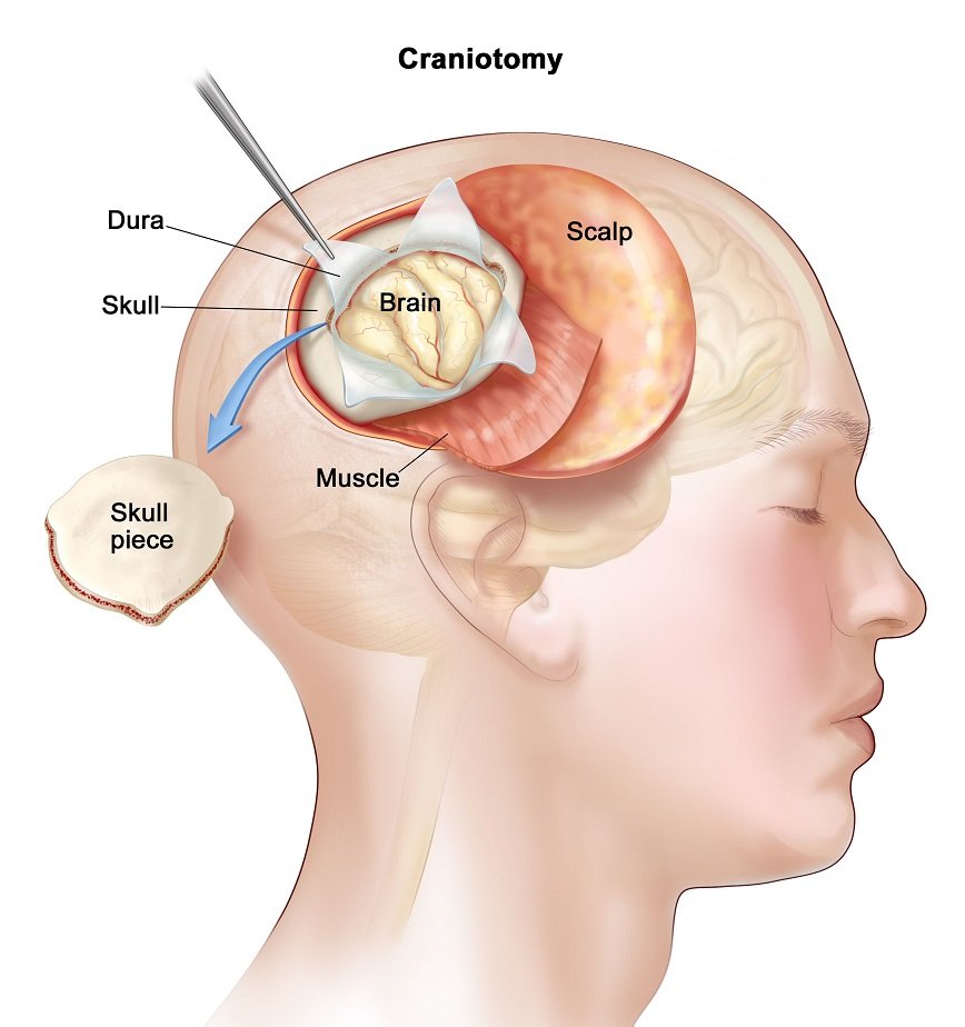 Brain Tumor Consultation