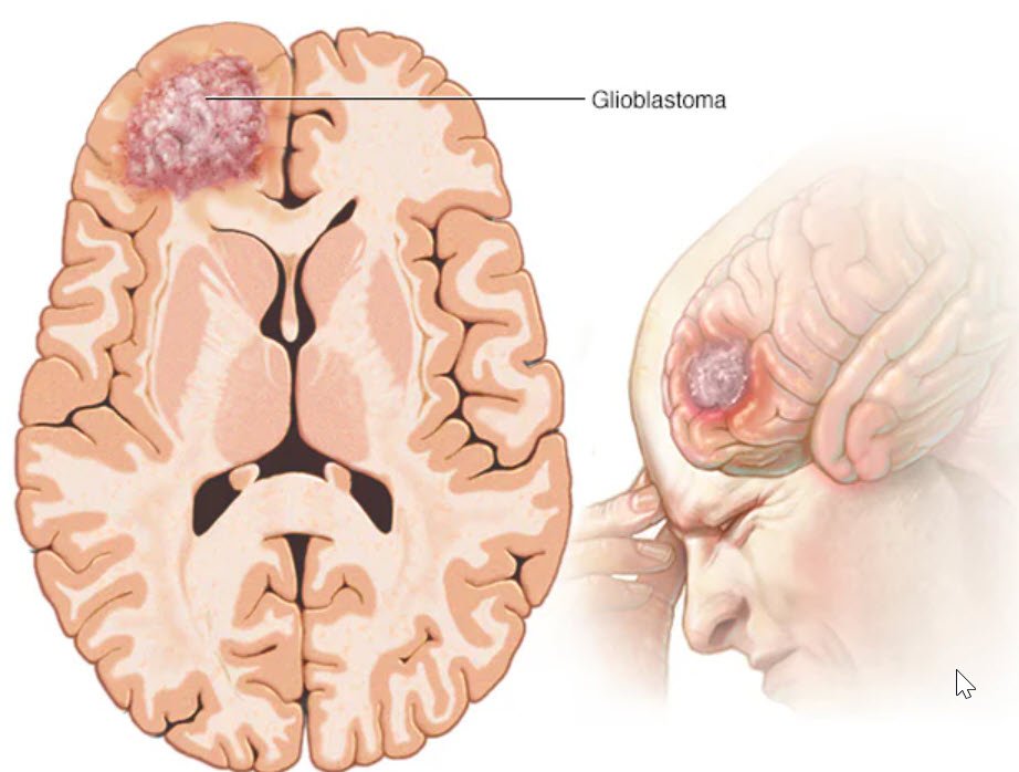 Brain Tumor Consultation Image 3