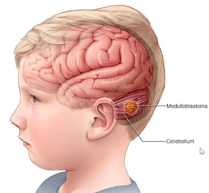 Brain Tumor Consultation Image 4